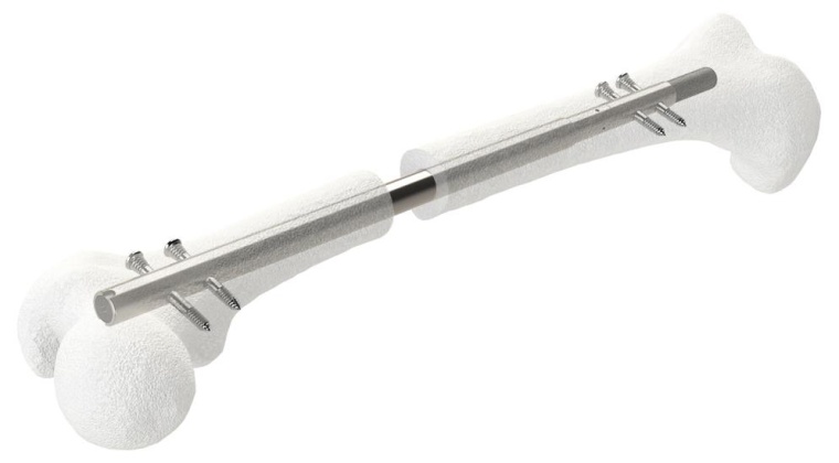 Synoste entwickelte ein Hightech-Implantat zur minimalinvasiven Behandlung von...
